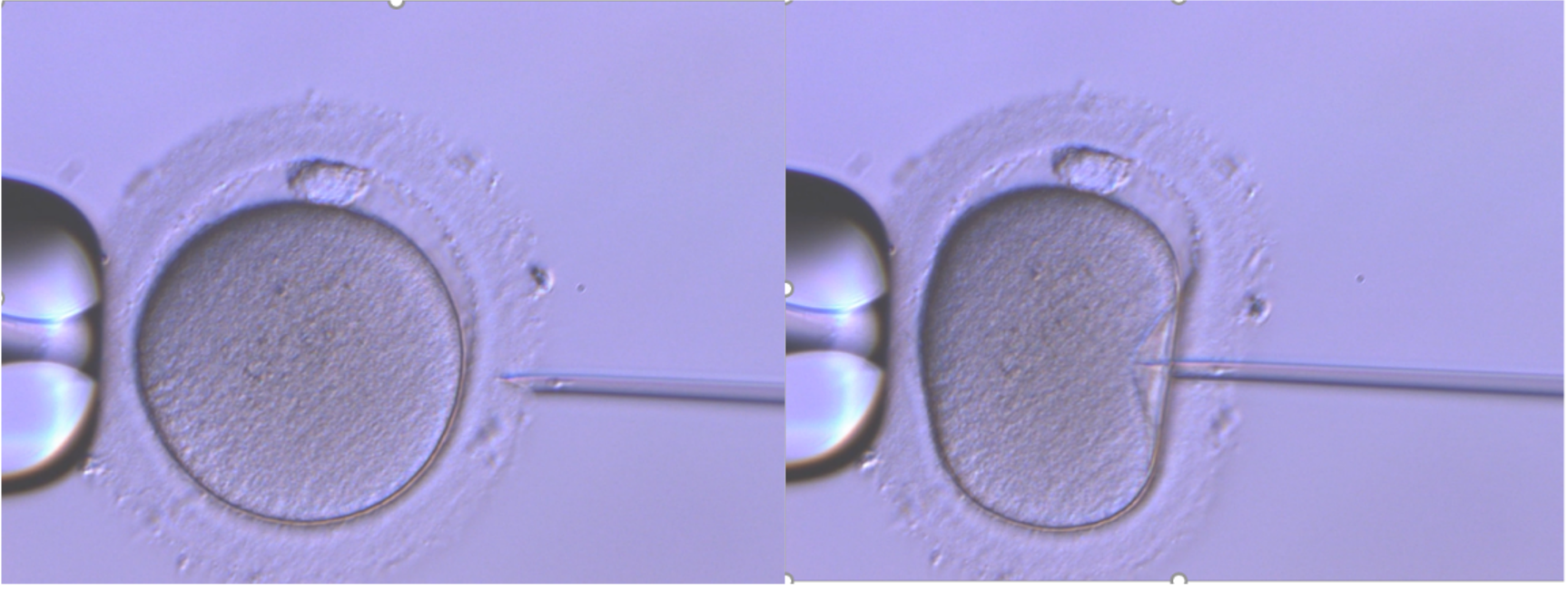 Mature egg undergoing ICSI