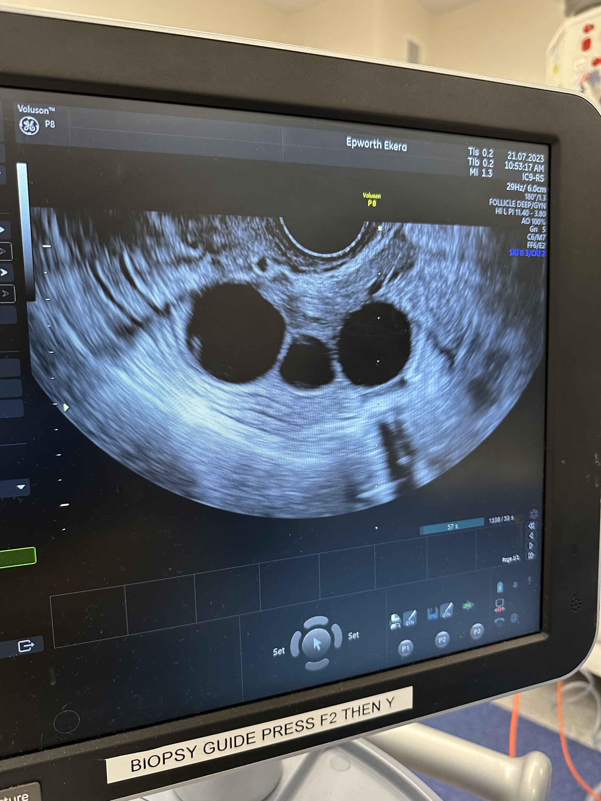 An ultrasound image showing the number of follicles within a woman's ovary